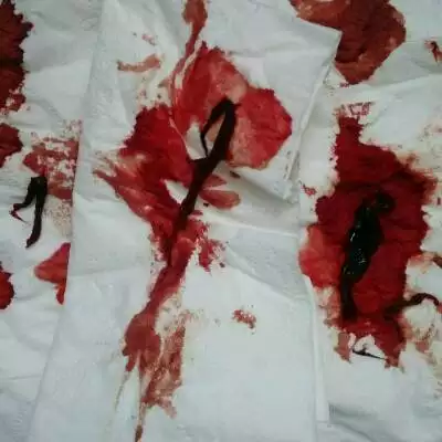 5周孕囊图片：35天的孕囊流下来的图片