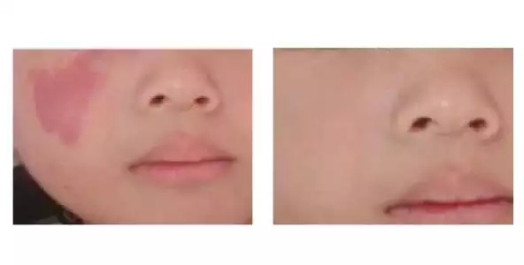 脸上的胎记会遗传给孩子吗：脸上有胎记会不会影响孩子的心理发育