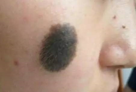 女人后背有胎记代表什么：女人后背有青色胎记好不好