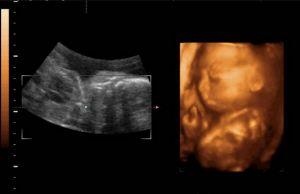 生儿子的四维彩超图片，b超单有这个一般是女孩