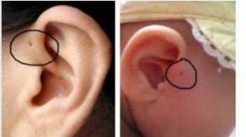 真童子的胎记长在什么位置，童子命的人送走童子后有什么变化