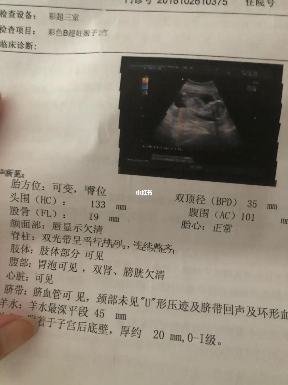 孕初期一招看男女,怀男孩很早就有感觉