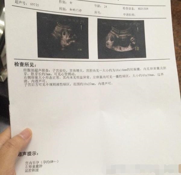 b超有两点基本是男孩，b超单上的秘密三数据