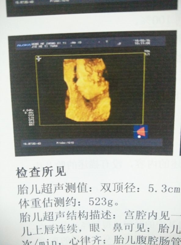 2、已生了女宝的四维单子:想知道是宝还是女宝宝?四维彩超声24周大小单子详细如下