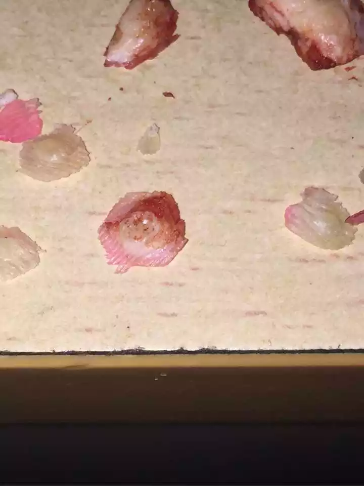 4、鸡眼被取出来的样子图片:鸡眼最终***是什么样子 图