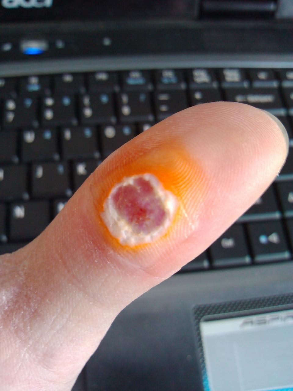 2、鸡眼被取出来的样子图片:鸡眼长手上什么样子图片