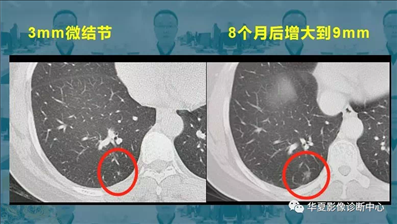 2、肺部有小于5mm结节，需要**吗？