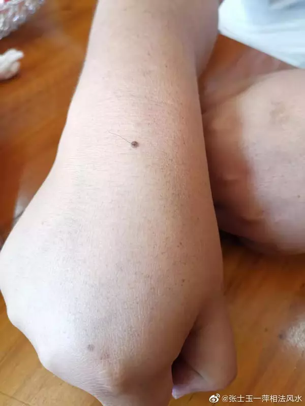 3、左手臂上有痣好不好