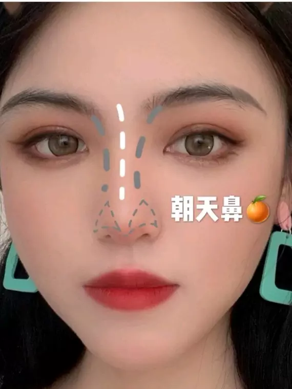 4、这是蒜头鼻吗?