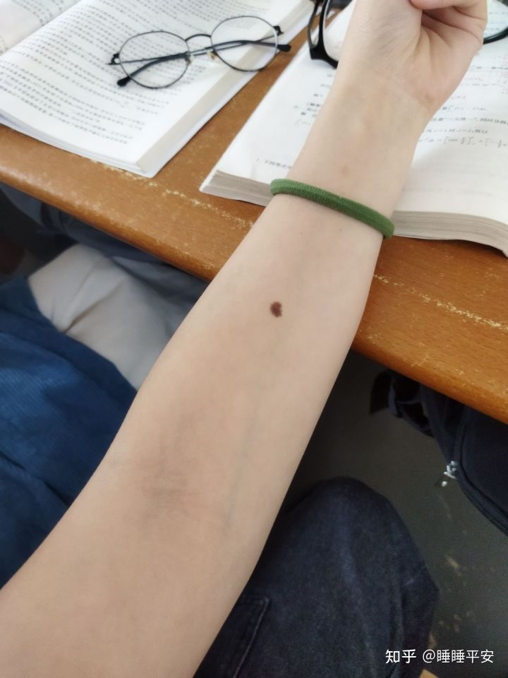 2、右胳膊上有痣代表什么意思