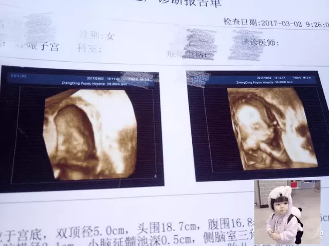 3、怎么查出是男孩还是女孩