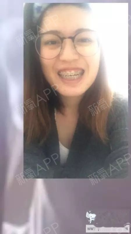 2、摘牙套前后，你的颜值变化有多大？