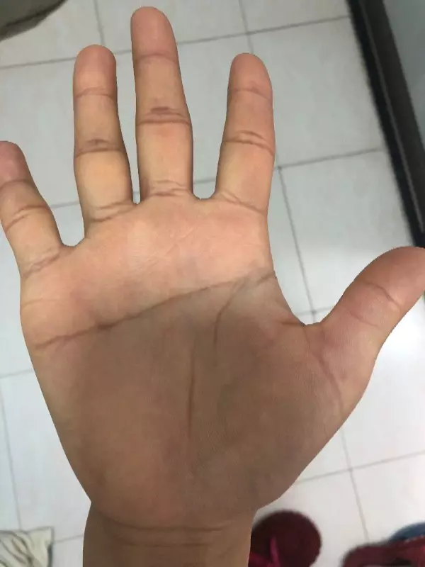 3、什么是断掌？