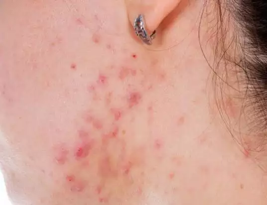 3、螨虫长什么样？肉眼能看到吗？