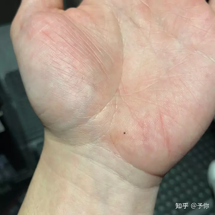 3、手臂内侧有痣代表什么意思 听说是前世姻缘未尽 今年再续？是这样吗？