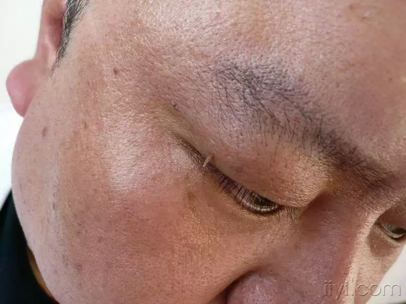 4、丝状疣有什么危害