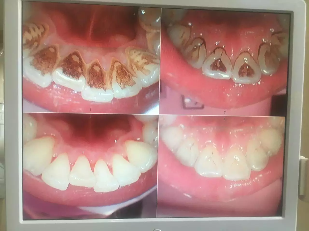 3、如果不去医院洗牙，牙结石是不是不能去除？
