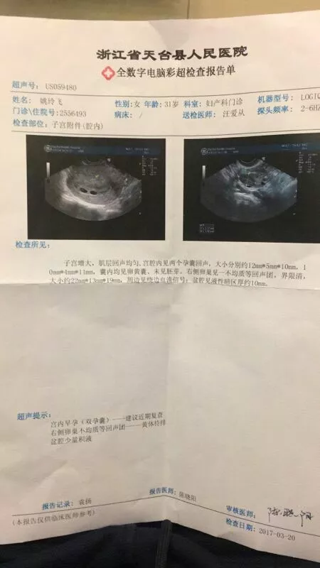 4、孕囊能判断生男生女吗