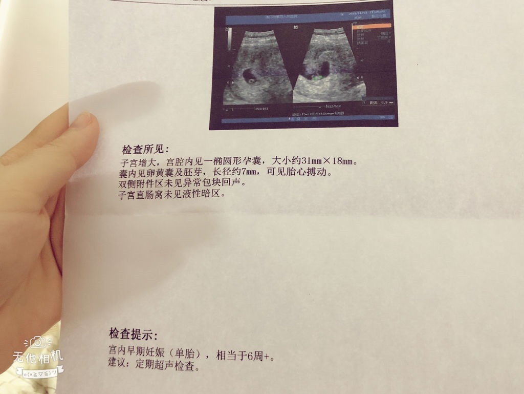 2、孕70天，孕囊40*32。能看出是男孩女孩吗？