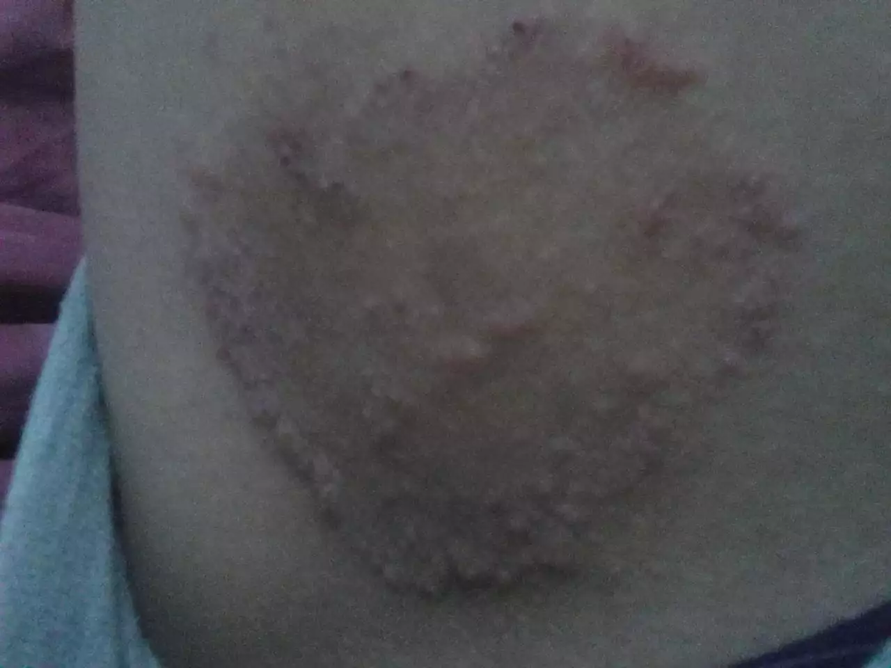 3、怎么区分湿疹和股癣？