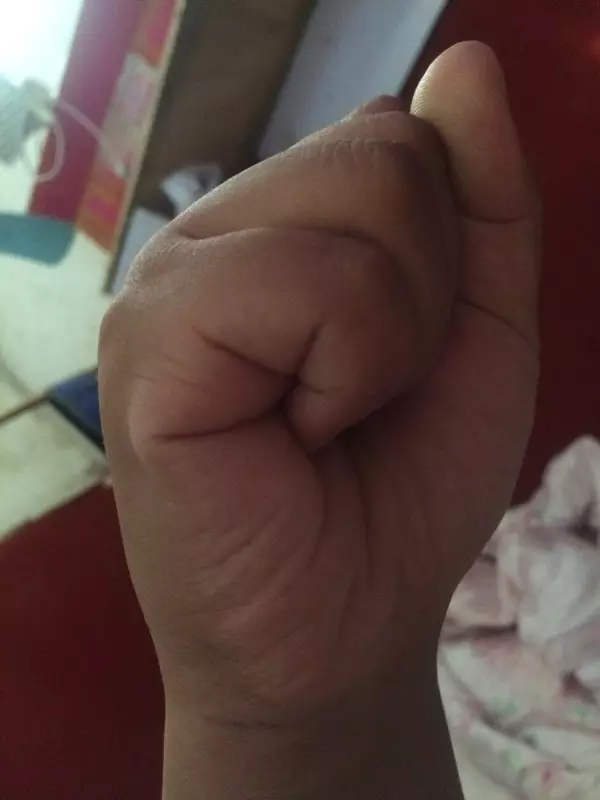 3、胎兒脊柱呈串珠樣是什么意思？