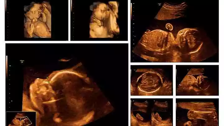 3、怎样通过四维彩超判断男孩还是女孩