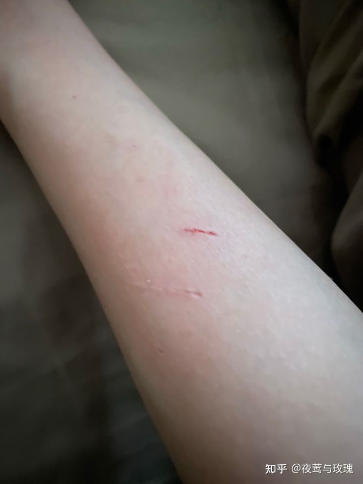 2、被猫抓伤以后,猫咪十天没死是不是人就没事