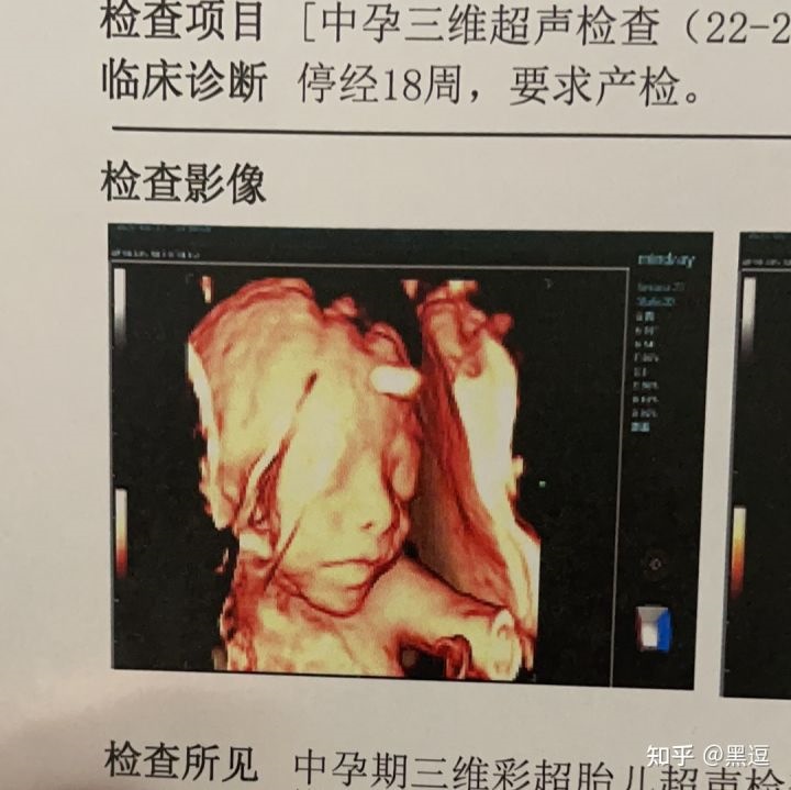 2、看四维彩超男孩女孩