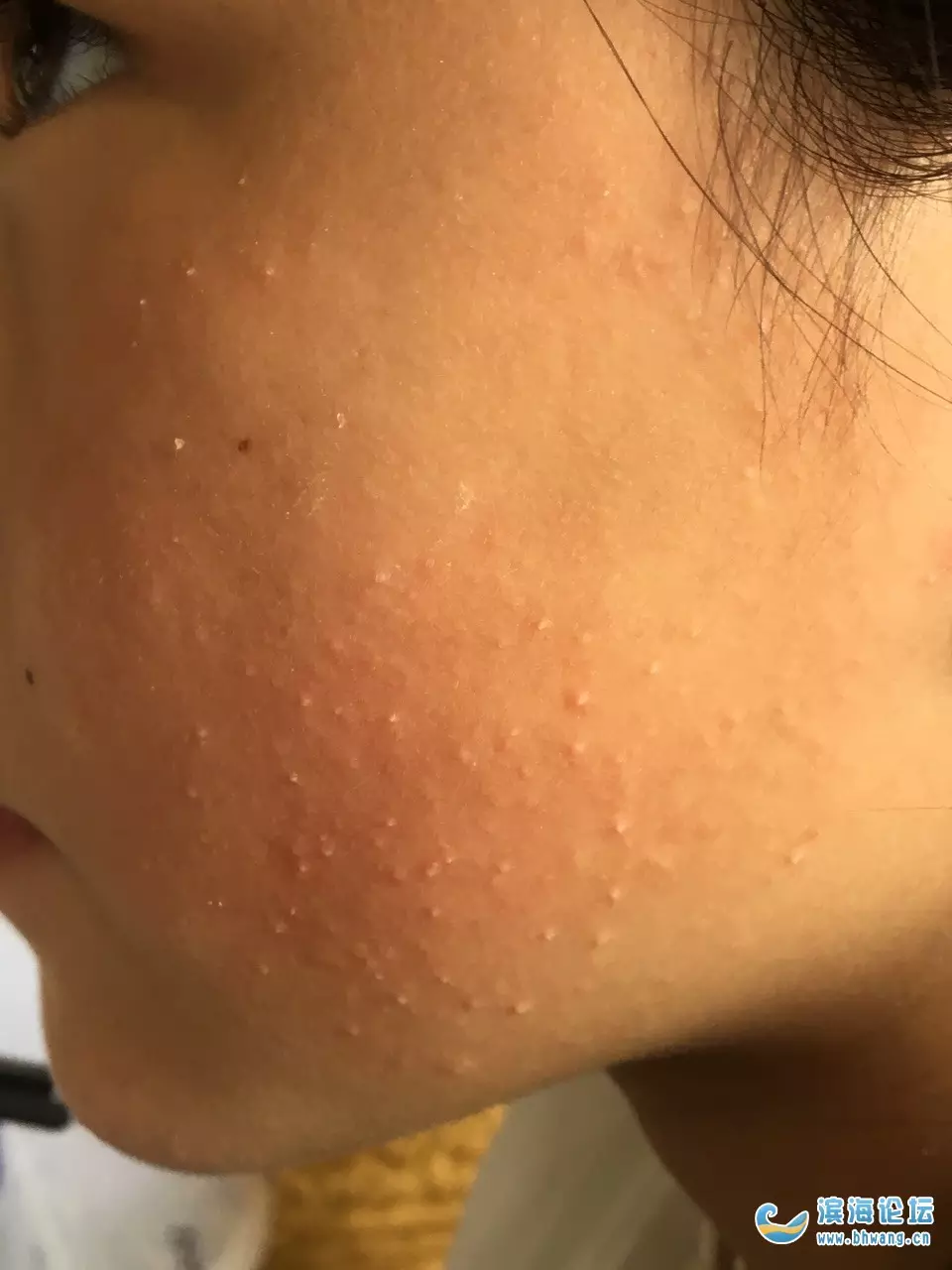 3、小孩八岁了身上很多痱子怎么办