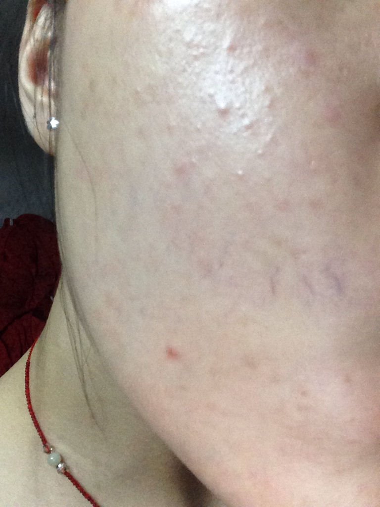 2、我家儿子8岁了脸上长了些象痱子一样的白粒是什么东西