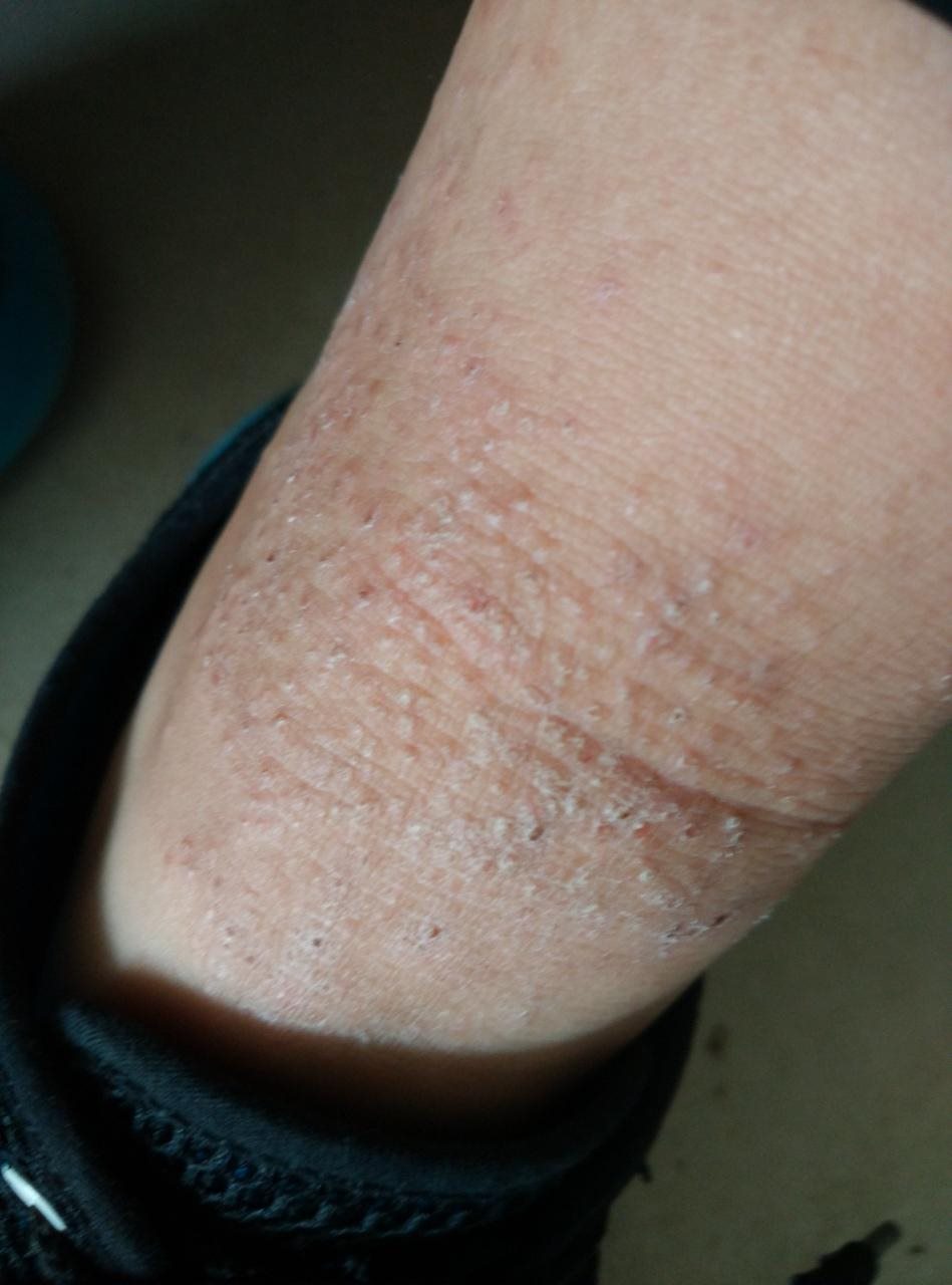 2、胳膊上的疙瘩怎么治？