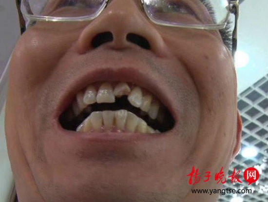 2、门牙掉了一个风水上来说是不是漏财