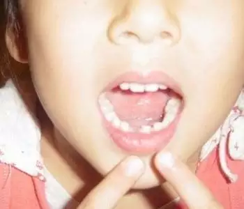 3、门牙掉了一半影响风水不