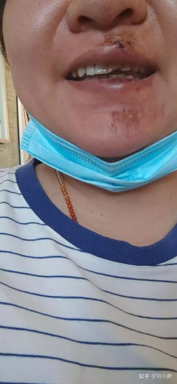 4、门牙无缘无故断了半边是怎么回事，能补好吗