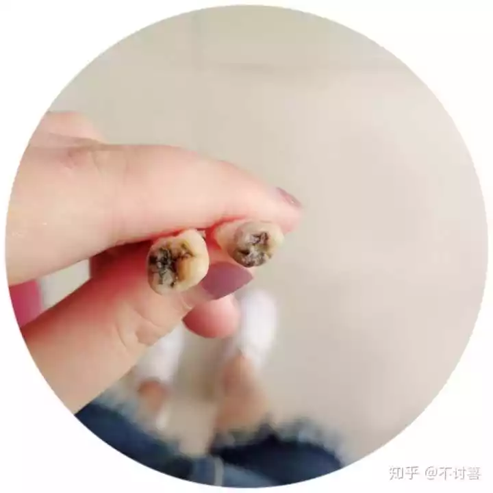 4、最晚多大长智齿？