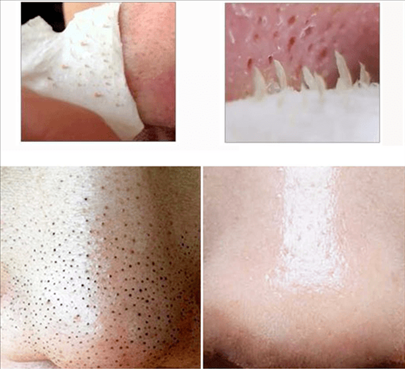 1、鼻子上脸上的黑头被我挤了.可是留下了一个洞. 难看死了.