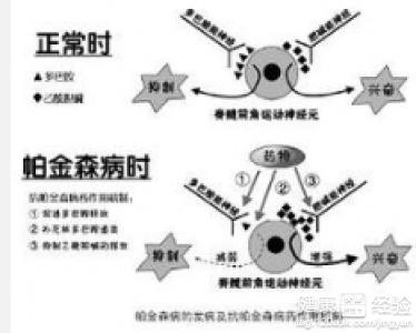 2、帕金森晚期什么症状？