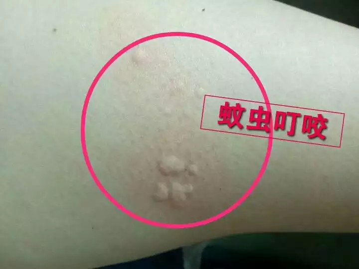 3、是像蚊子咬的那种包，怎样判断是螨虫咬的还是