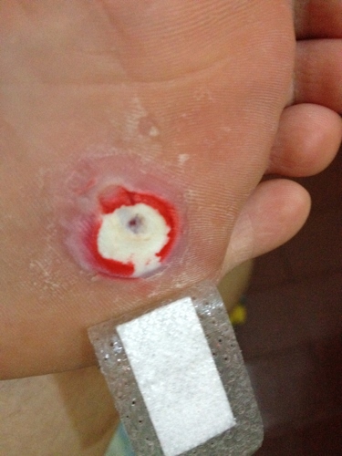 2、鸡眼图片挖出 图片