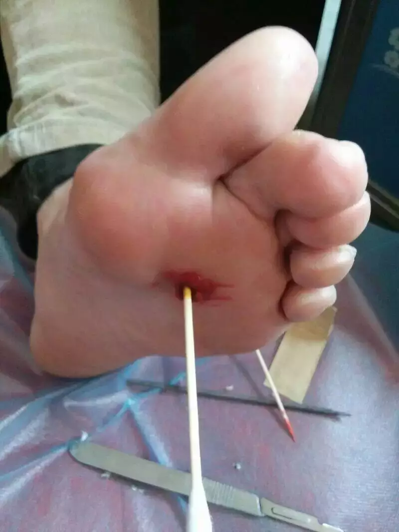 4、我的鸡眼被挖出来了。里面看不到黑色的了 们看看我的鸡眼怎么样了