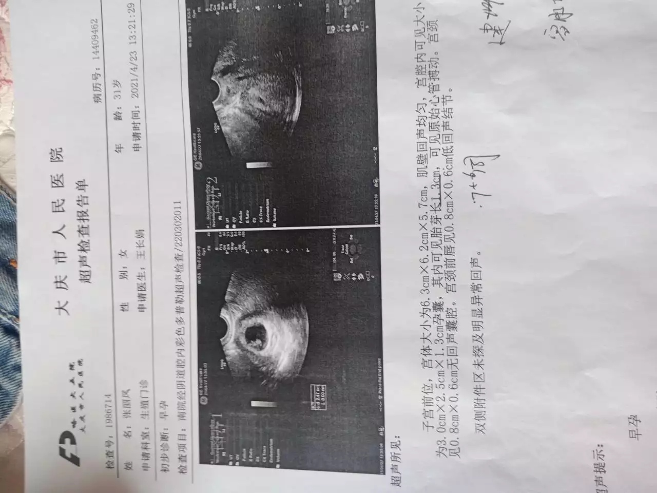 4、孕囊看男女还是准的