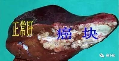 2、谁能救救我爸，我爸刚被查出来肝癌晚期，医生说现在**的方法就是，但是只能有几个月的生命了，我不