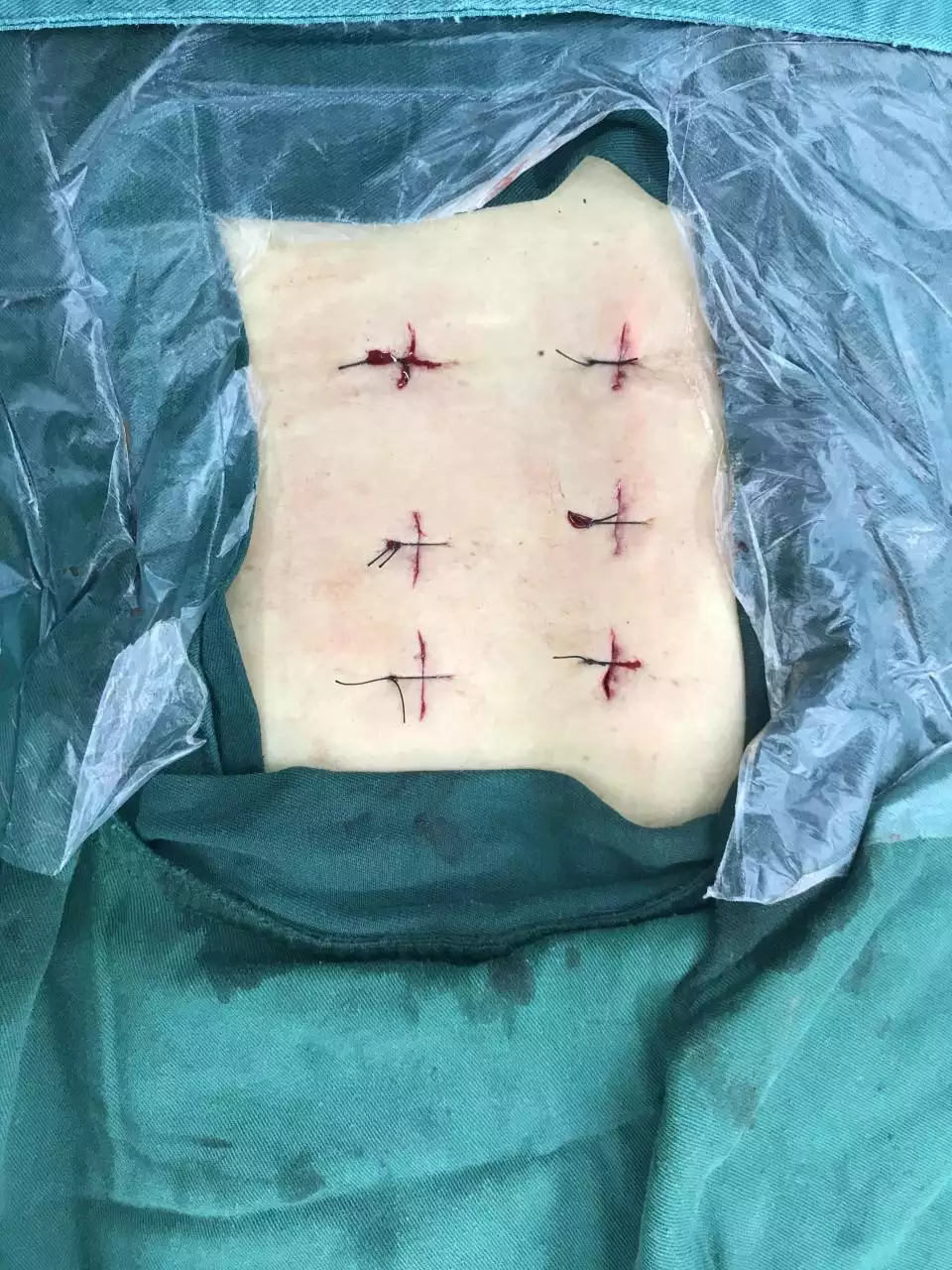 3、患者做微创手术会有后遗症吗？