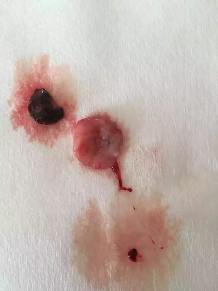 3、孕囊是什么样子的？我图片上这个是吗？这样子流的完整吗？