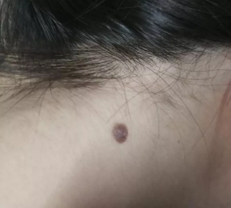 3、询问，这种对称的痣有什么说法