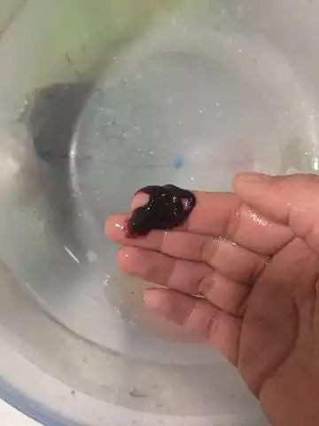 4、药流孕囊时会疼吗