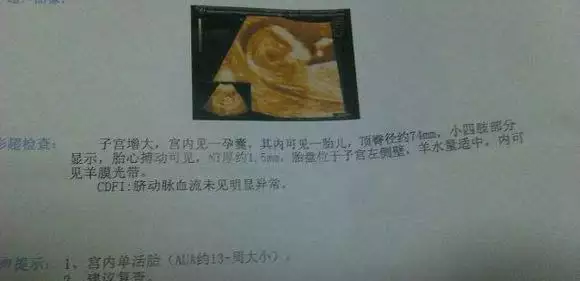 3、无创DNA检测数据18高于13和21是还是女宝