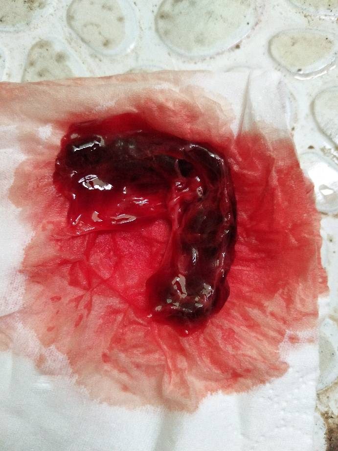 2、药流第三天排岀孕囊还是有隐隐痛可以躺下休息吗