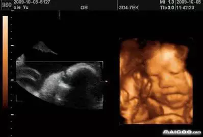 4、四维彩超看见一个尖尖的亮点坚在那里底下还有两个黑黑的蛋是男孩吗？