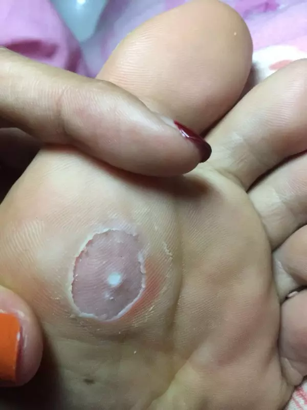 3、请问我这是不眼（图）